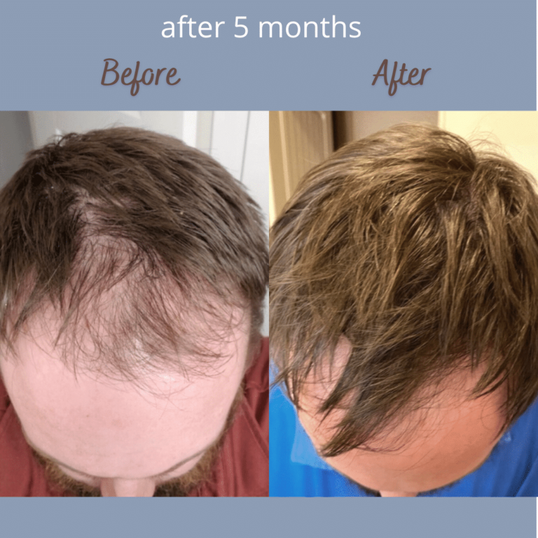 Hair Growth with LLLT Laser Cap (Advanced Non Surgical Procedure)